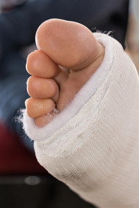 玻璃腿玻璃纤维/石膏腿铸造照片