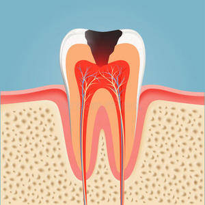 搪瓷 医疗保健 脓肿 运河 细菌 感染 衰退 发炎 龋病