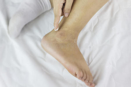 专注于脚踝和手指上的乳液，女性在干燥的脚踝上涂上乳液，粗糙或不光滑，在床上滋润干燥的脚踝