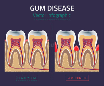 牙龈疾病载体