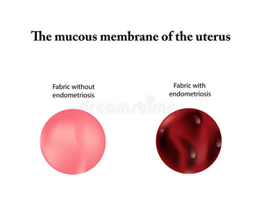 子宫内膜异位症。 子宫腺肌病。 子宫内膜。 孤立背景上的矢量插图