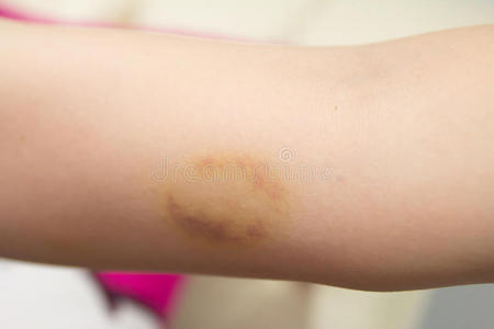 皮下出血摄影图 皮下出血图片大全 皮下出血照片 摄图新视界