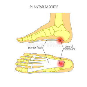 韧带 条件 筋膜炎 人类 脚后跟 损伤 照顾 踝关节 解剖