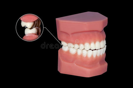 咬牙切齿牙磨牙关闭