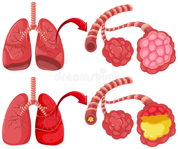 插图 人类 解剖 器官 艺术 图表 健康 生物学 科学 疾病