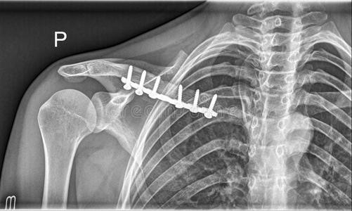 肩部锁骨骨折图片