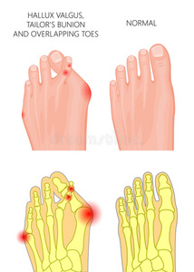 健康 拇趾 疼痛 老茧 铁锤 关节炎 解剖 畸形 踝关节