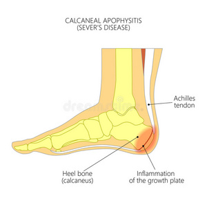 跟骨骨突炎