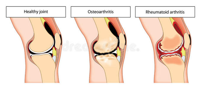 关节炎膝关节