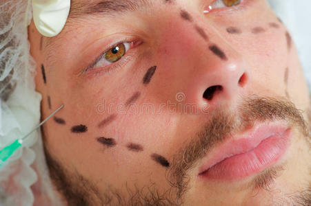 特写年轻人的脸，黑线画在它周围，接受面部美容治疗注射，医生的手