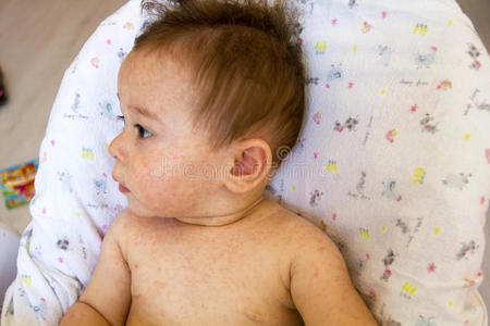 婴儿皮炎皮疹问题。 因食物过敏而过敏。 皮肤脸颊上的特写特应性症状。 概念