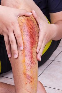 拥抱膝盖手拥抱受伤的膝盖与痛苦的磨损从秋天照片