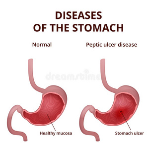 人体健康和不健康胃的解剖