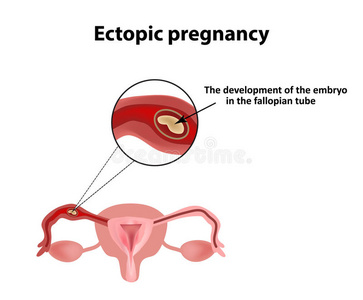 异位妊娠。 输卵管中的胚胎。 信息图表。 背景上的矢量插图
