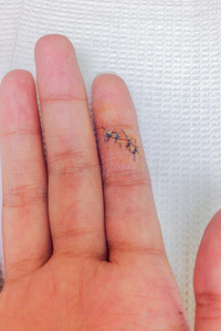 右手食指割伤后,伤口缝合手指照片