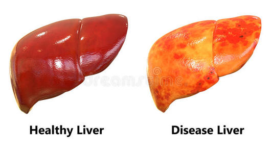 身体 炎症 插图 解剖 器官 肝炎 医学 生物学 胆囊 疾病