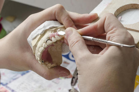 缺口部分牙科技师做丙烯酸树脂的部分假牙.照片