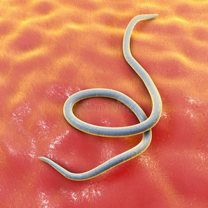 蛲虫病图片
