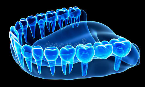 搪瓷 王冠 假肢 射线 义齿 提供 提取 伦琴 牙本质 固定装置