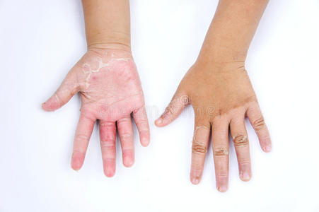 干手,果皮,接触性皮炎,真菌感染,皮肤感染照片
