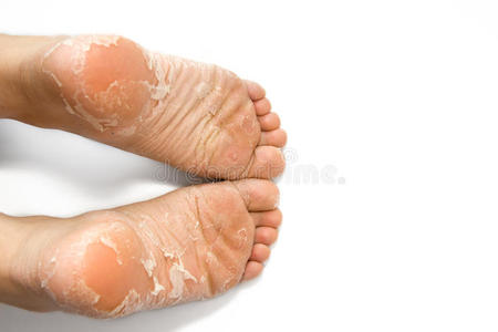 足部护理女高跟鞋之前和之后的程序皮肤不好脚踵布满裂缝脚跟与糟糕的