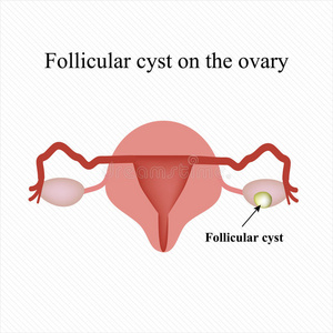 卵泡卵巢囊肿。 功能。 信息图表。 矢量插图