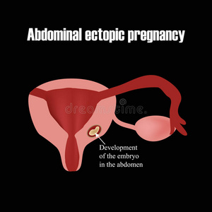 腹部胚胎的发育。 异位妊娠。 信息图表。 矢量插图