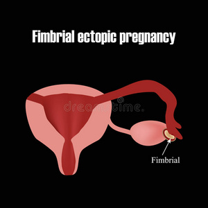 胚胎在胚胎部的发育。 异位妊娠。 信息图表。 矢量插图