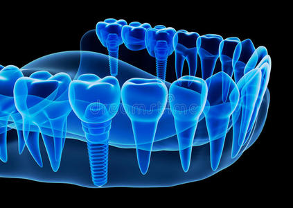 假肢 牙科 搪瓷 医学 诊断 射线 下巴 义齿 提供 固定装置