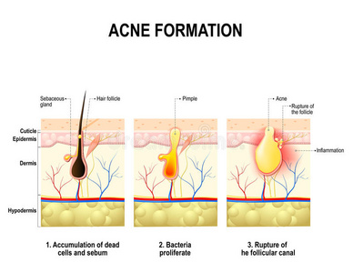 痤疮的形成。 人类的皮肤。