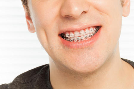 金属 正畸 搪瓷 照顾 牙科 健康 校准器 嘴唇 男人 深的