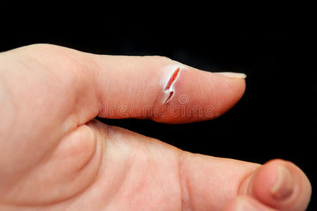 手指伤口手指上有一个很深的伤口照片