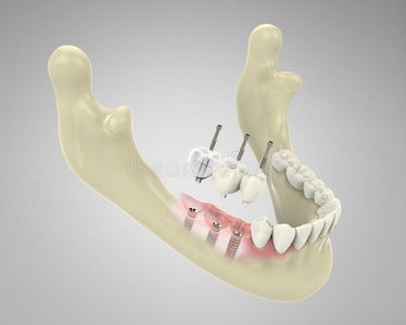 三维渲染牙齿