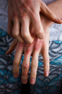 特写男子手痒和抓挠. 手上有银屑病或湿疹. 特应性过敏皮肤有红斑照片