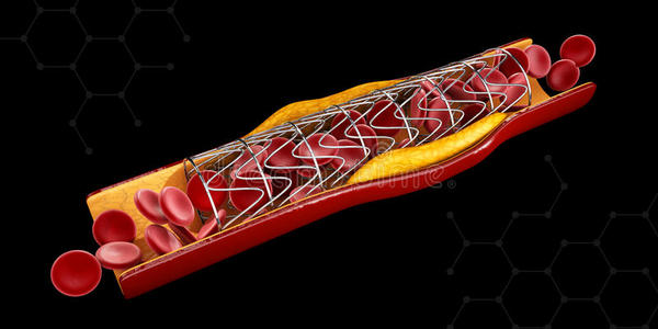 药物治疗 梗塞 插图 解剖 胆固醇 金属 循环 植入 心脏病学