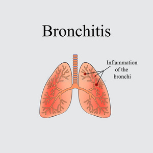 支气管炎。 人类肺的解剖结构。 灰色背景上的矢量插图