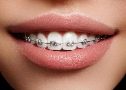 漂亮的白牙和牙套。 牙科护理照片。 女人微笑与牙齿配件。 正畸治疗