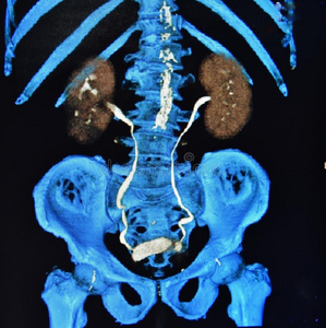 肾ctct扫描三维ct尿路造影肾膀胱彩色照片