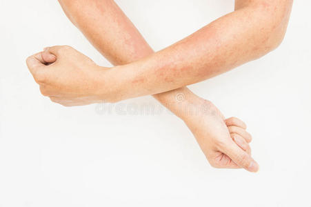 过敏 皮肤科 人类 条件 病人 皮炎 小孩 身体 蚊子 疼痛