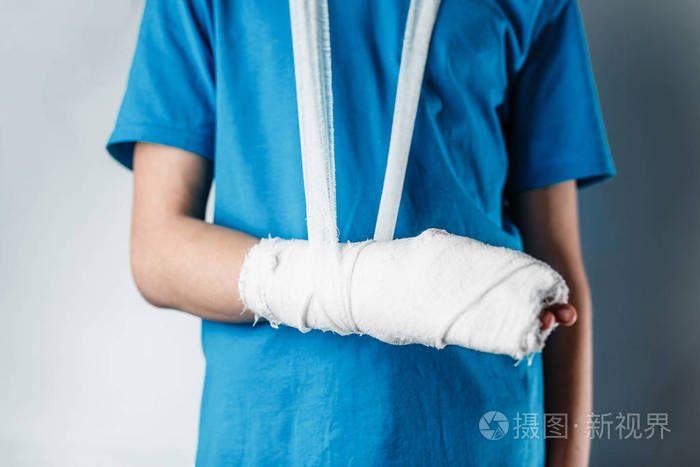 涂了石膏的胳膊一只断了的胳膊