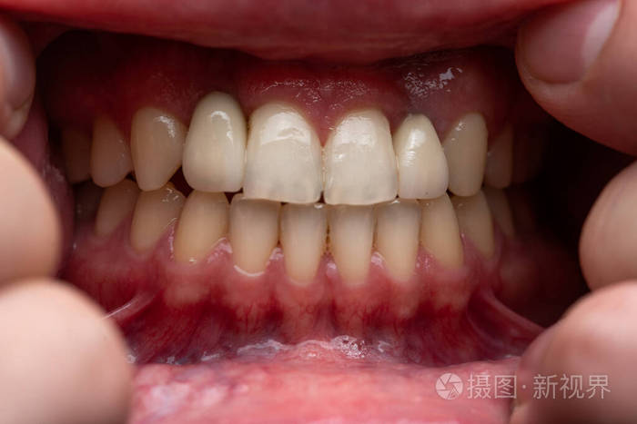 年轻人的照片露出牙齿特写