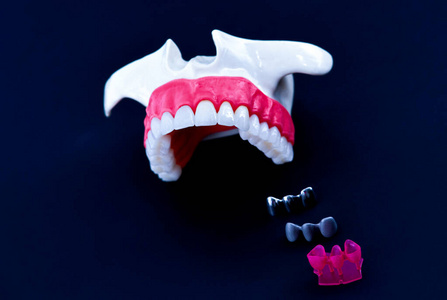 牙种植体和牙冠安装工艺图片