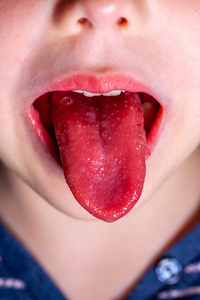 舌头发红的孩子