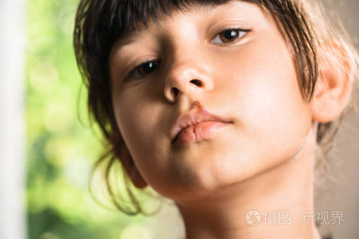 小女孩上唇疱疹嘴唇上有冻疮的孩子