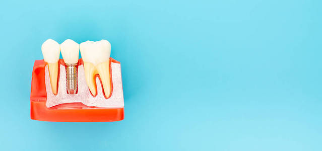 牙齿植入物的塑料样品与天然牙齿进行比较。