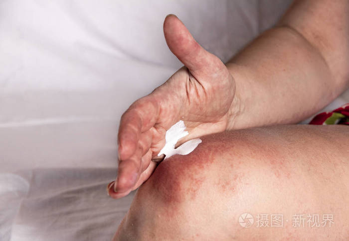 过敏治疗