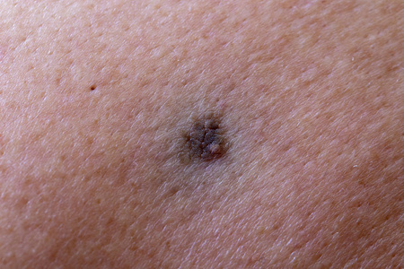 黑色素瘤的初期照片