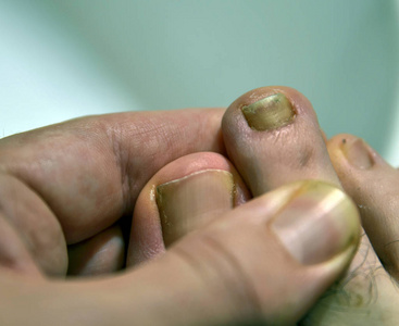 Closeup image of a fingernail on the right foot of a Caucasian 