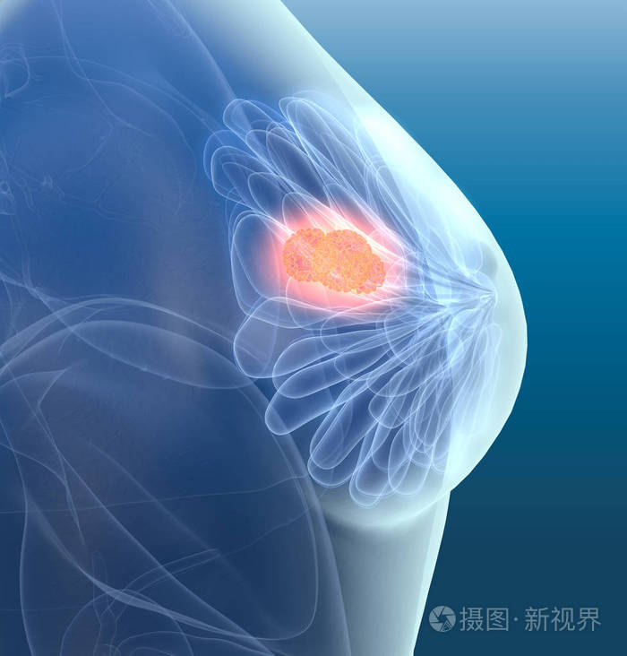 乳腺癌伴淋巴管,医学3d插图照片-正版商用图片25zui5-摄图新视界