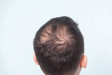 发型 损失 控制 开销 肖像 强调 年代 秃顶 后退 脱发